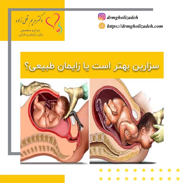 سزارین بهتر است یا زایمان طبیعی؟