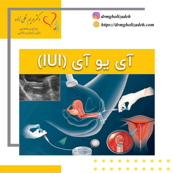 IUI