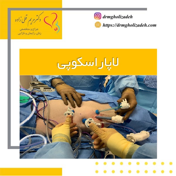 لاپاراسکوپی